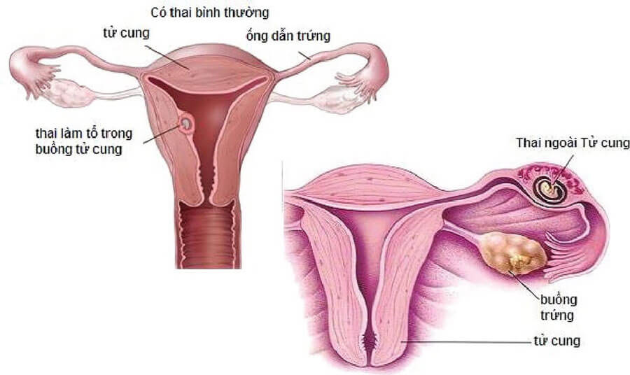 Dấu hiệu mang thai ngoài tử cung  UEBE Vietnam