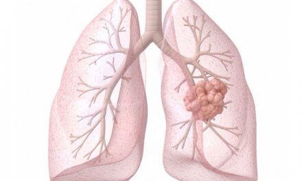 Cách phòng bệnh ung thư phổi đúng là gì?