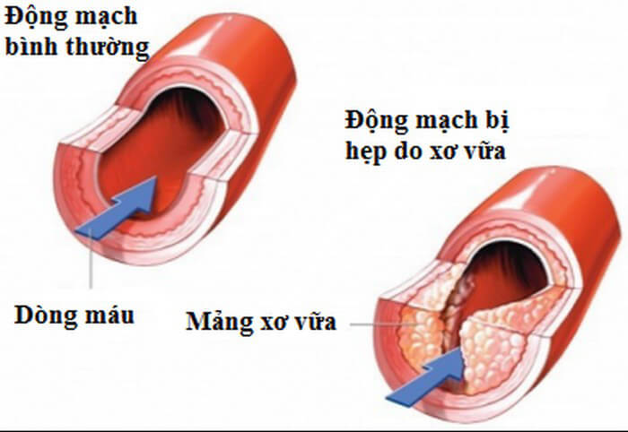 đột quỵ