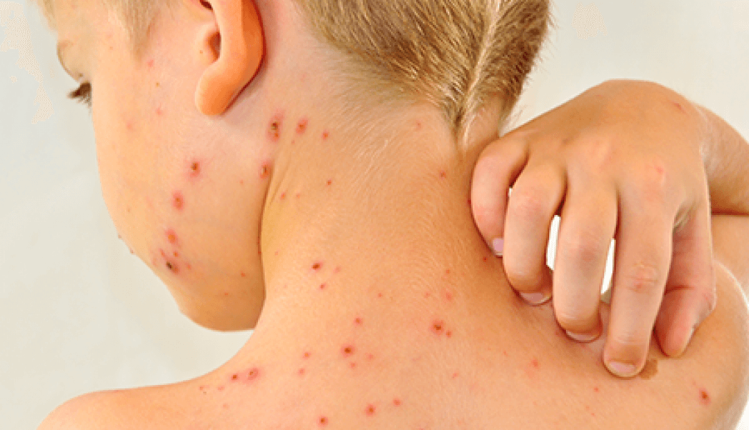 Các bệnh về da thường gặp và cách ngừa hay